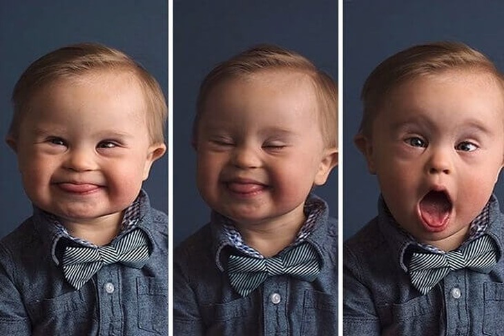 Hôn nhân cận huyết thống : 9 căn bệnh di truyền nguy hiểm mà đứa trẻ sinh ra có thể mắc - Ảnh 5.