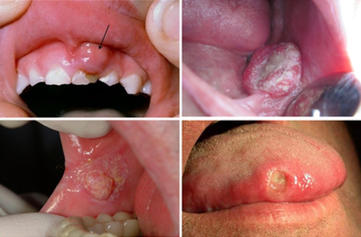 Ung thư khoang miệng: Biểu hiện, điều trị và cách chăm sóc đúng  - Ảnh 3.