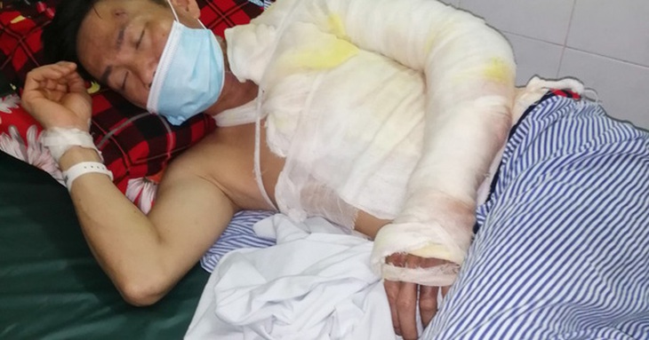 Xót xa hoàn cảnh người đàn ông bị bỏng nặng những ngày cận Tết