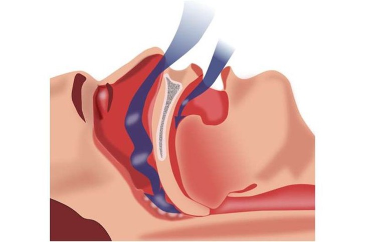 Chứng ngưng thở khi ngủ gây hại cho mắt như thế nào? - Ảnh 1.