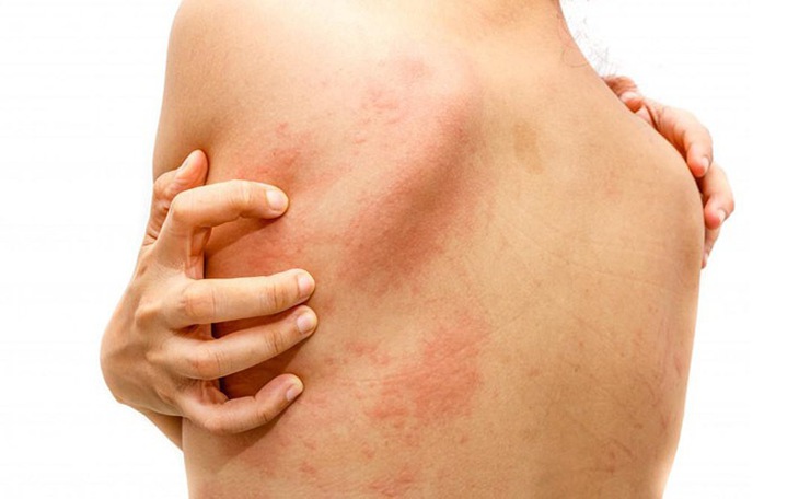 Nguyên nhân gây phát ban đỏ trên da và cách khắc phục