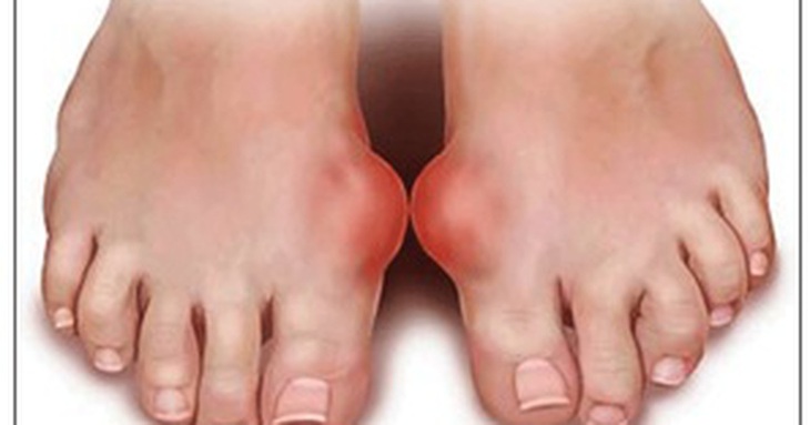 Những sai lầm thường gặp ở người bệnh gout - Ảnh 2.