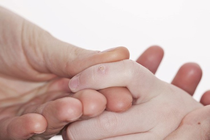 Có những ngoại mụn cóc nào, cách gì chữa trị? - Ảnh 1.
