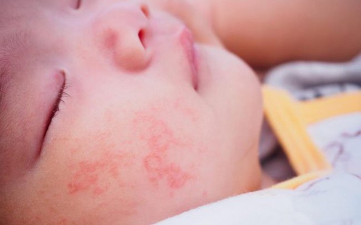 Chăm sóc trẻ viêm da cơ địa đúng cách khi thời tiết chuyển mùa