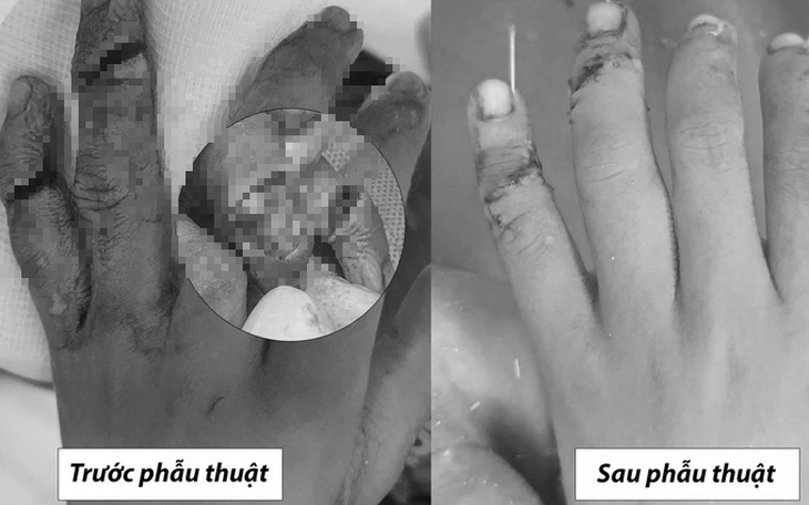 Anh sơ ý trong lúc nấu cơm khiến 2 ngón tay của em trai 7 tuổi gần đứt rời
