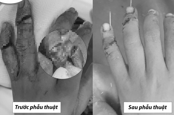 Anh sơ ý trong lúc nấu cơm khiến ngón tay của em trai 7 tuổi gần đứt rời - Ảnh 1. Anh sơ ý trong lúc nấu cơm khiến ngón tay của em trai 7 tuổi gần đứt rời - Ảnh 1.