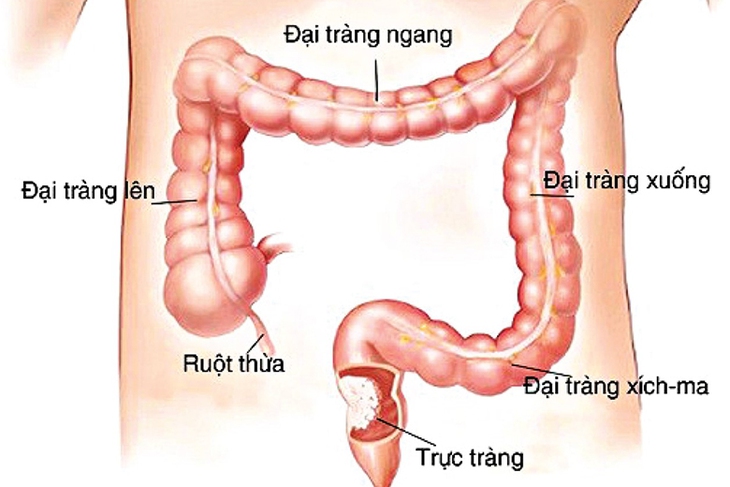 Viêm đại tràng: Nguyên nhân, biểu hiện, cách điều trị và phòng bệnh- Ảnh 1. Viêm đại tràng: Nguyên nhân, biểu hiện, cách điều trị và phòng bệnh- Ảnh 1.