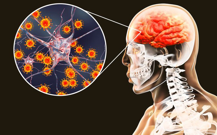 Cần cảnh giác với viêm não cấp ở trẻ