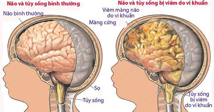 Cần cảnh giác với viêm não cấp ở trẻ - Ảnh 2.