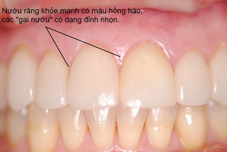 Ngăn ngừa viêm nướu răng bằng chế độ dinh dưỡng hiệu quả - Ảnh 3.