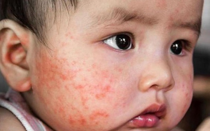 Nguyên nhân gây dị ứng thời tiết ở trẻ và cách chăm sóc