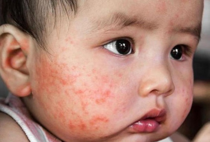 Nguyên nhân gây dị ứng thời tiết ở trẻ và cách chăm sóc - Ảnh 2.