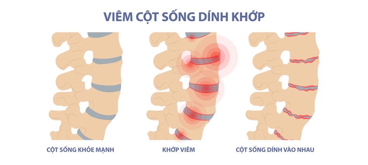 Dấu hiệu nhận biết và lưu ý về vận động thể dục ở người bệnh viêm cột sống dính khớp - Ảnh 1.