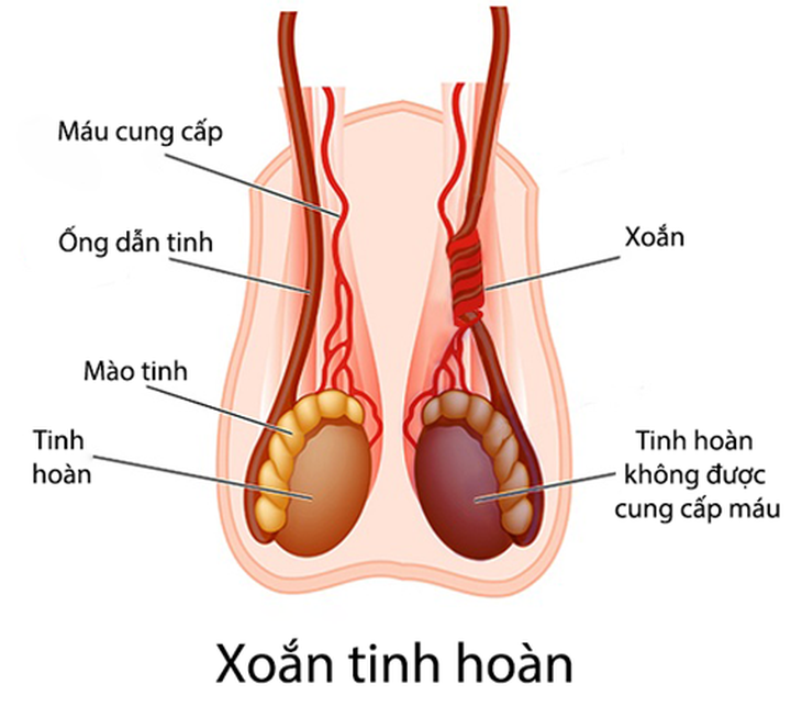 Xoắn tinh hoàn, cấp cứu nam khoa nếu không xử trí kịp thời có thể dẫn tới vô sinh - Ảnh 1.