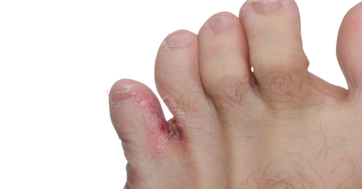Điều trị nấm kẽ chân sau mưa bão - Ảnh 1.