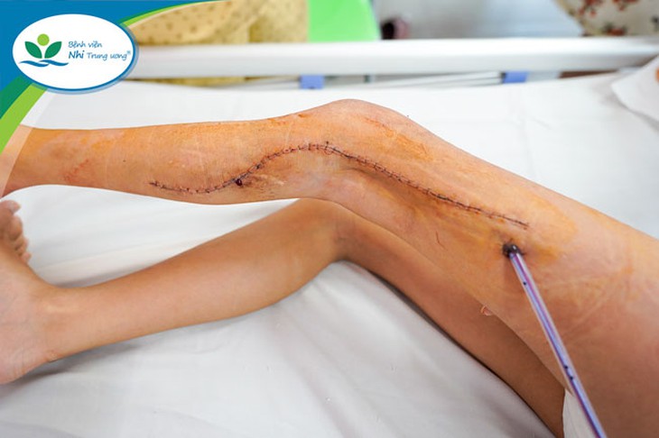 Bé gái 9 tuổi đã nhiều năm đau đớn, không đi lại được vì chân có khối dị dạng tĩnh mạch - Ảnh 1. Bé gái 9 tuổi đã nhiều năm đau đớn, không đi lại được vì chân có khối dị dạng tĩnh mạch - Ảnh 1.