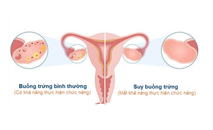 Phát hiện dấu hiệu suy buồng trứng sớm để can thiệp kịp thời - Ảnh 2.