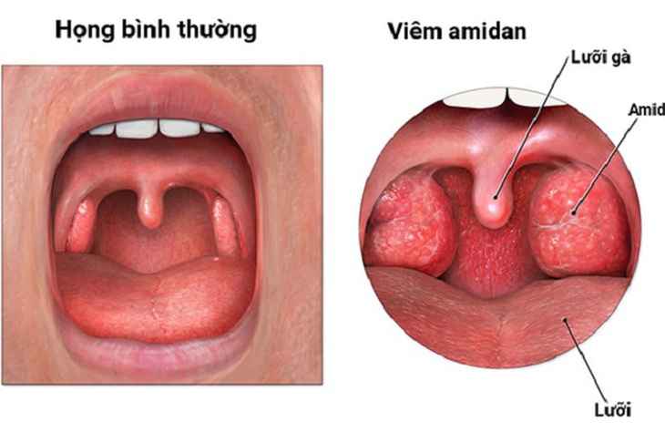 Viêm amidan khi nào nên cắt? - Ảnh 1.