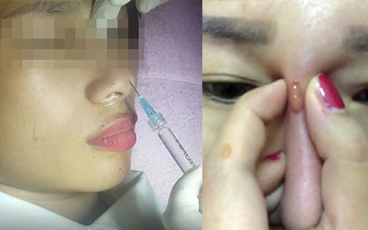 Bác sĩ cảnh báo những biến chứng sau tiêm filler nâng ngực, mũi, xóa nhăn...