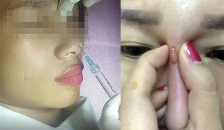 Bác sĩ cảnh báo những biến chứng sau tiêm filler nâng ngực, mũi, xóa nhăn... - Ảnh 2. Bác sĩ cảnh báo những biến chứng sau tiêm filler nâng ngực, mũi, xóa nhăn... - Ảnh 2.