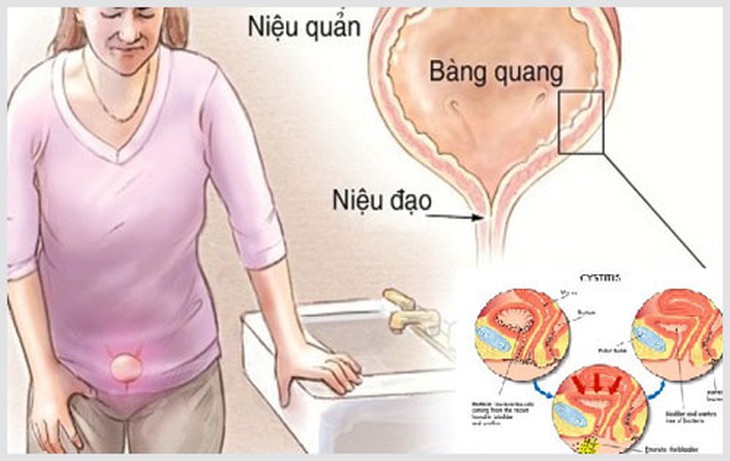 Chữa viêm đường tiết niệu do vi khuẩn - Ảnh 1.