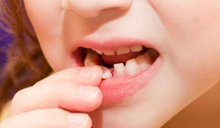 Chăm sóc răng cho trẻ ở độ tuổi thay răng - Ảnh 2.
