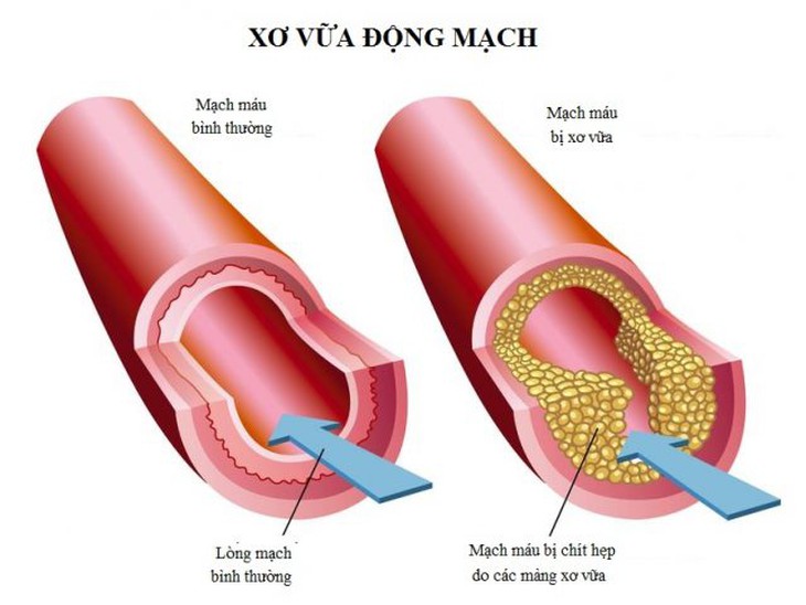 Yếu tố nào làm tăng nguy cơ xơ vữa động mạch và người trẻ có dễ mắc? - Ảnh 1.