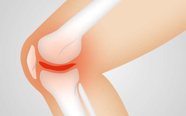 Liệu pháp mới có thể điều trị và ngăn ngừa viêm xương khớp