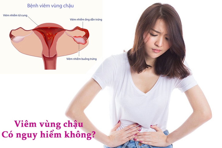Bệnh viêm vùng chậu điều trị như thế nào? - Ảnh 3.