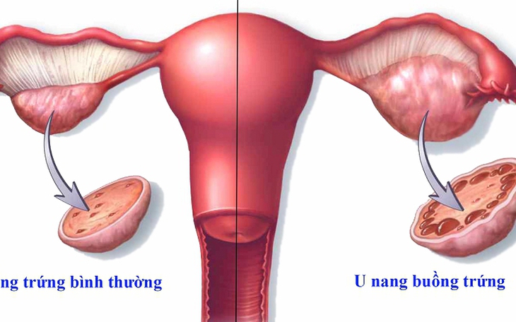 U buồng trứng khi mang thai có nguy hiểm?