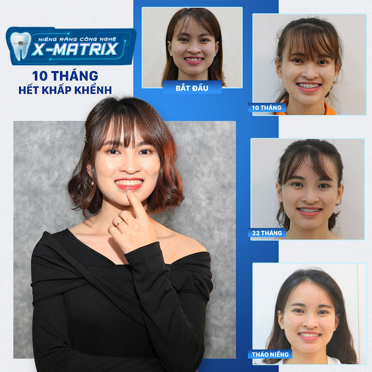 Mách bạn mắc cài nào tốt nhất, tiết kiệm chi phí cho sinh viên - Ảnh 3.