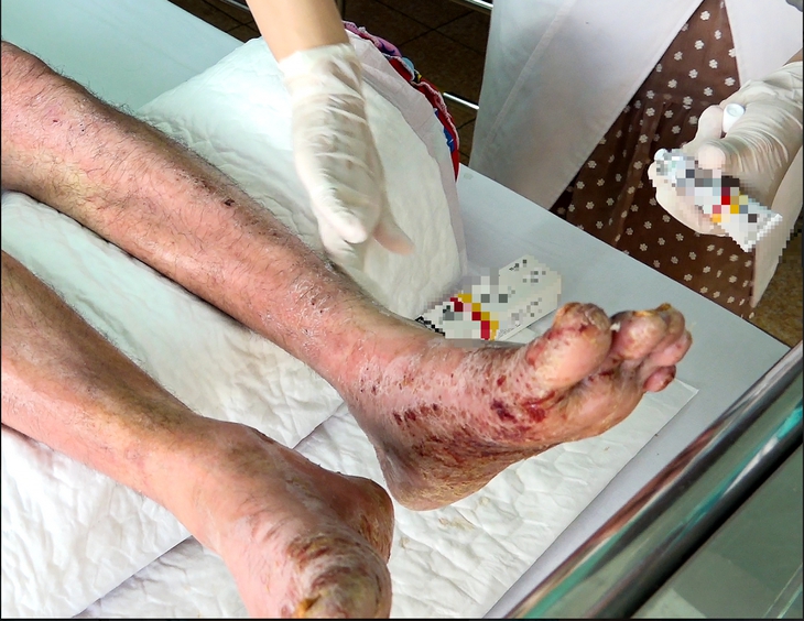 Bệnh nhân viêm da cơ địa nhiễm trùng nặng do chích vỡ các mụn nước  - Ảnh 1.