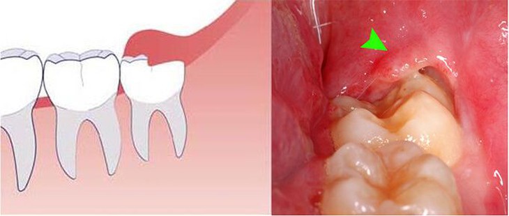 Viêm lợi trùm có thực sự đáng lo? - Ảnh 1.