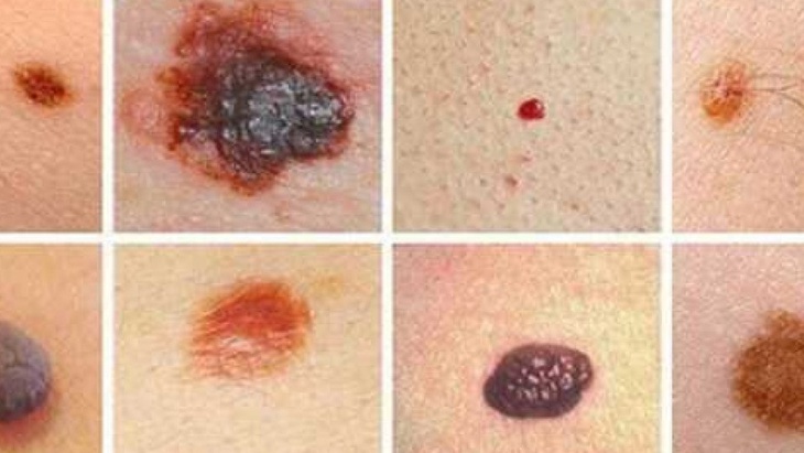 Thuốc mới giúp làm giảm 58% nguy cơ tử vong do ung thư hắc tố ác tính - Ảnh 1.