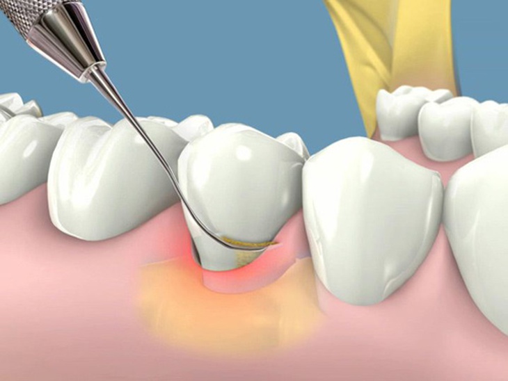 Viêm lợi khi mang thai có ảnh hưởng gì? - Ảnh 3.