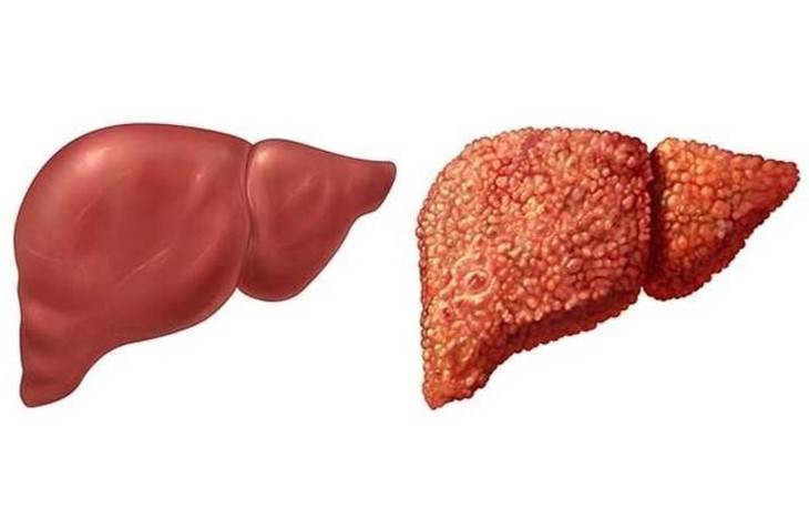 Giải pháp hỗ trợ bảo vệ và tăng cường chức năng gan - Ảnh 1.