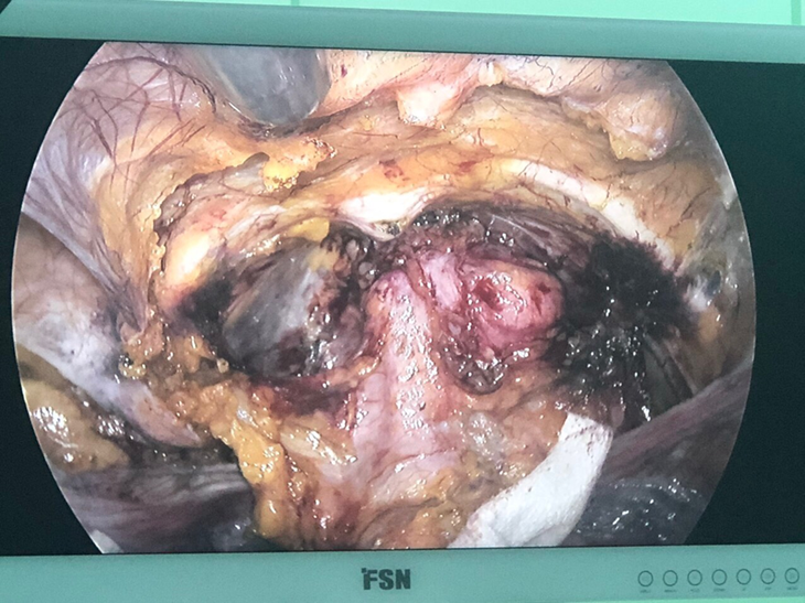 Phẫu thuật nội soi điều trị 6 mặt bệnh sàn chậu trở thường quy tại Bệnh viện đa khoa TP Vinh - Ảnh 5. Phẫu thuật nội soi điều trị 6 mặt bệnh sàn chậu trở thường quy tại Bệnh viện đa khoa TP Vinh - Ảnh 5.