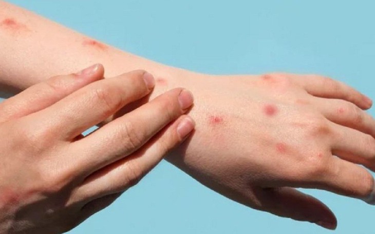Nhiễm HIV và nguy cơ mắc bệnh đậu mùa khỉ trầm trọng