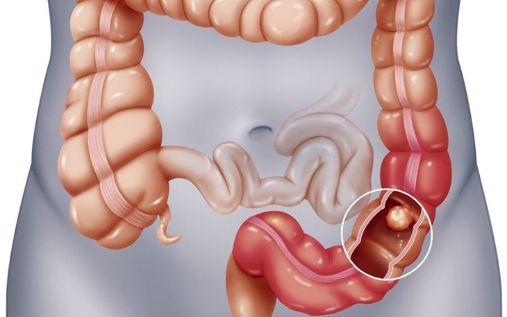 Polyp đại tràng và các yếu tố nguy cơ gây bệnh