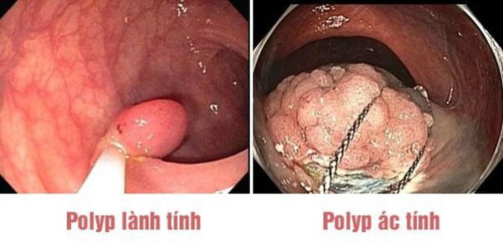 Khi nào polyp đại trực tràng thành ác tính? - Ảnh 1.
