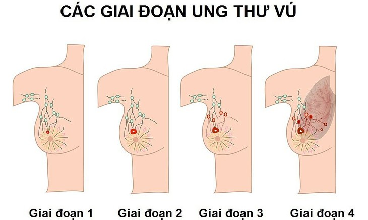 Ung thư vú có yếu tố di truyền nhưng bạn hoàn toàn có thể phòng ngừa được bằng thay đổi lối sống - Ảnh 3. Ung thư vú có yếu tố di truyền nhưng bạn hoàn toàn có thể phòng ngừa được bằng thay đổi lối sống - Ảnh 3.