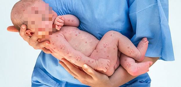 Giải đáp những thắc mắc về bệnh đậu mùa khỉ đối với thai kỳ - Ảnh 3.