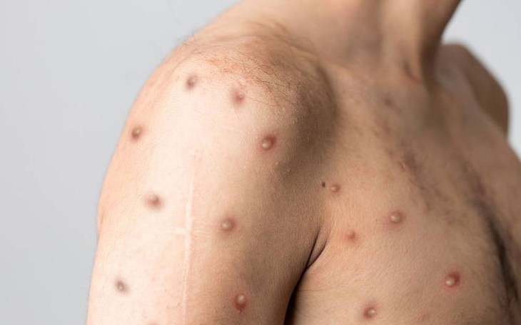 TP.HCM phát hiện ca đậu mùa khỉ đầu tiên