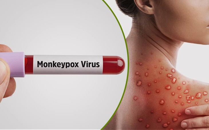 Phòng ngừa bệnh đậu mùa khỉ đừng quên bảo vệ sức khỏe tình dục