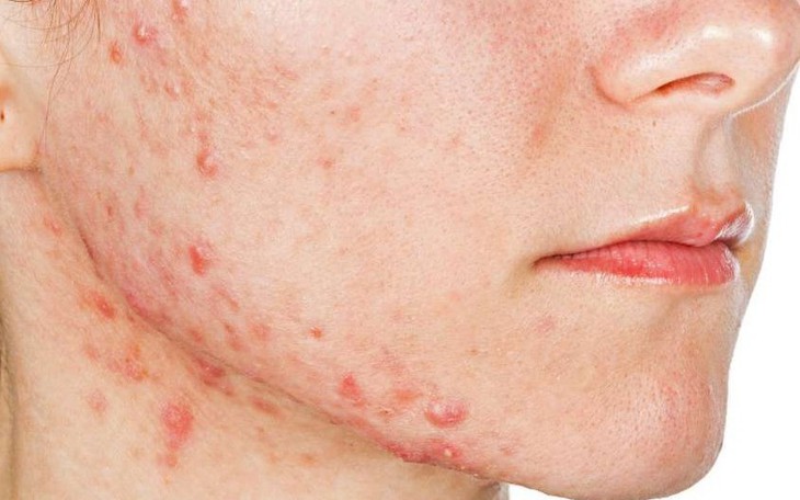 Mụn trứng cá do thuốc, cách nhận biết và điều trị