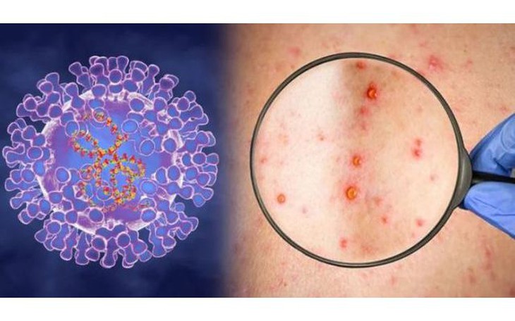Việt Nam đã triển khai những giải pháp gì ứng phó với dịch bệnh đậu mùa khỉ?