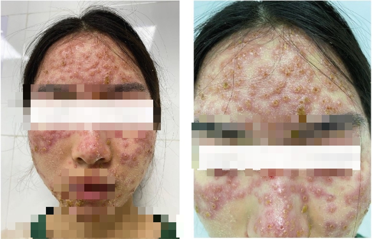 Mặt loang lổ mụn nước sau khi đắp mặt nạ detox chữa trứng cá - Ảnh 1.