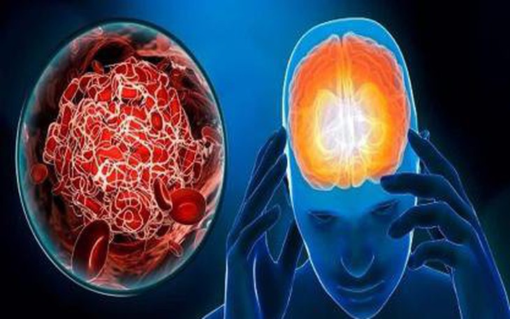8 thay đổi lối sống giúp ngăn ngừa đột quỵ