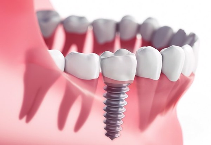 Vì sao nên cấy Implant ở phòng mổ áp lực dương? - Ảnh 2.