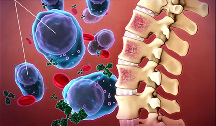 FDA chấp thuận thuốc mới điều trị cho bệnh nhân đa u tủy xương tái phát hoặc khó chữa - Ảnh 1.